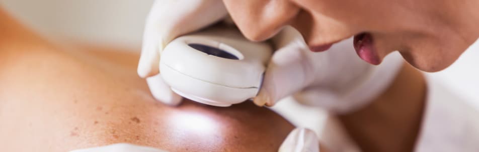 Benign Skin Lesions Treatment Fort Lauderdale