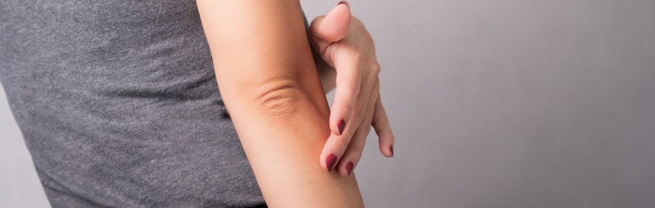 Eczema Fort Lauderdale