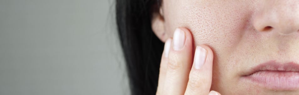 Rosacea Treatment Fort Lauderdale