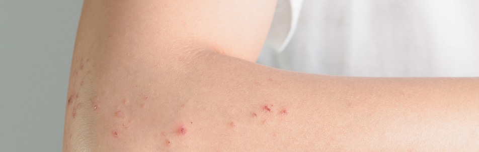 Shingles Treatment Fort Lauderdale