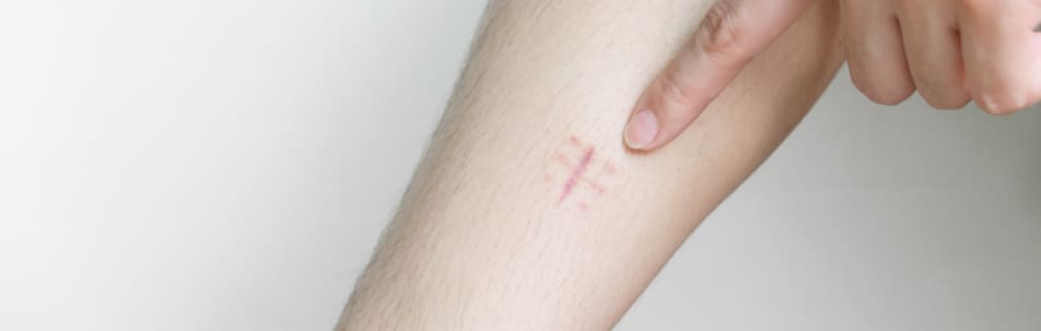 Hypertrophic Scars Fort Lauderdale