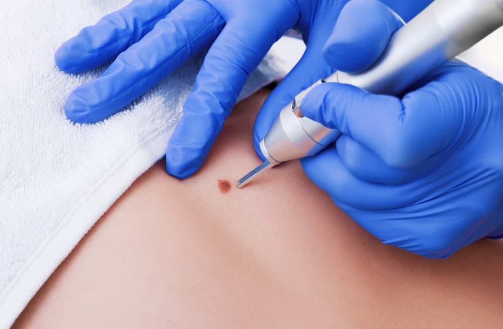 Birthmarks Removal Fort Lauderdale