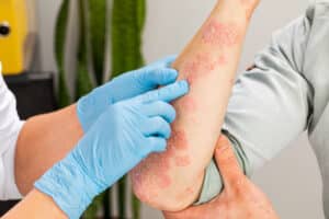 Doctor examining hereditary psoriasis on man’s arm