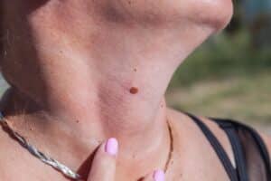 Close up of an older woman’s neck with a visible mole that she should check regularly to maintain skin health