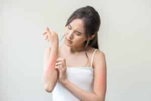 Young woman scratching at winter-related rash on her arm