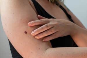 A close-up shot of moles on a woman's arm